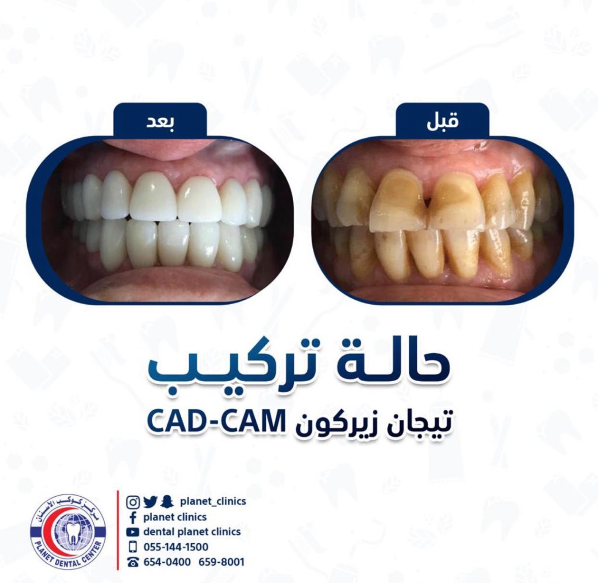 حالة تركيب تيجان زيركون CAD-CAM قبل وبعد