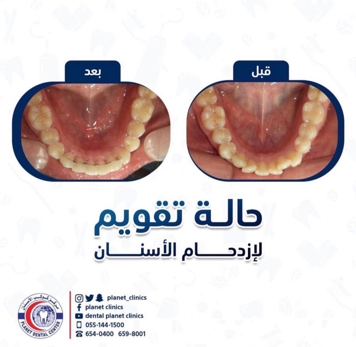 حالة تقويم لازدحام الأسنان قبل وبعد
