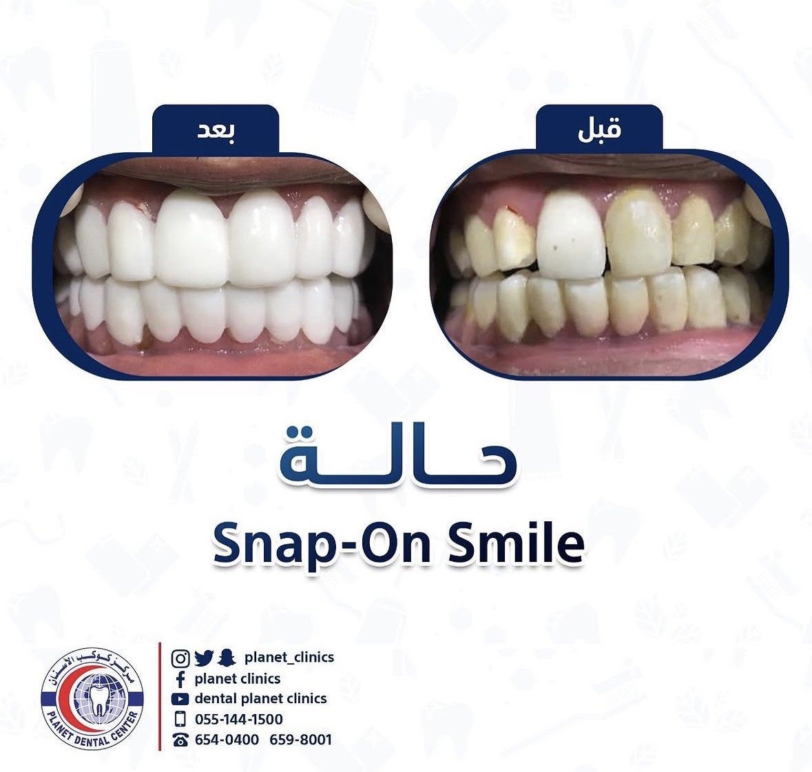 حالة Snap-On Smile قبل وبعد